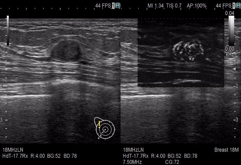 Breast-cut-DFI-4-Breast-0002