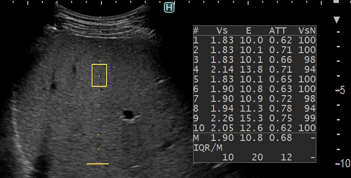 Эластометрия сдвиговой волной (SWM) и измерение индекса затухания (ATT) в гепатологии