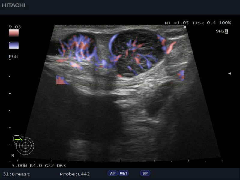 breast-eflow-D9CCCC44