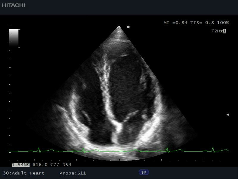 cardiac-la-b-EF5896C2