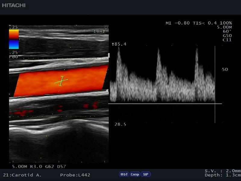 carotid-autoopt-pw-CDE389C1