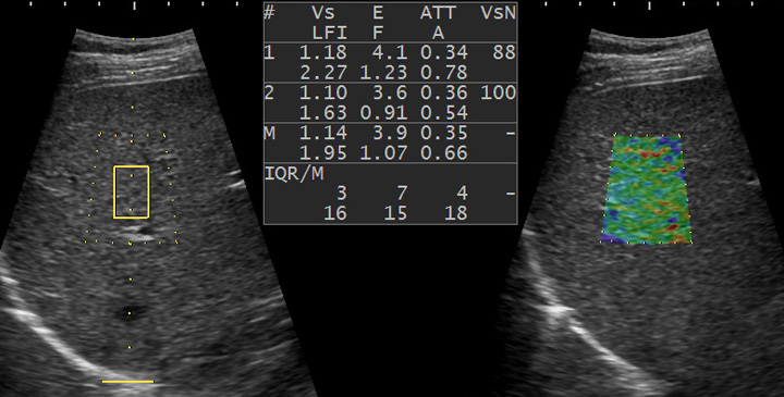 Диагностика фиброза печени и воспаления печени с помощью эластографии
