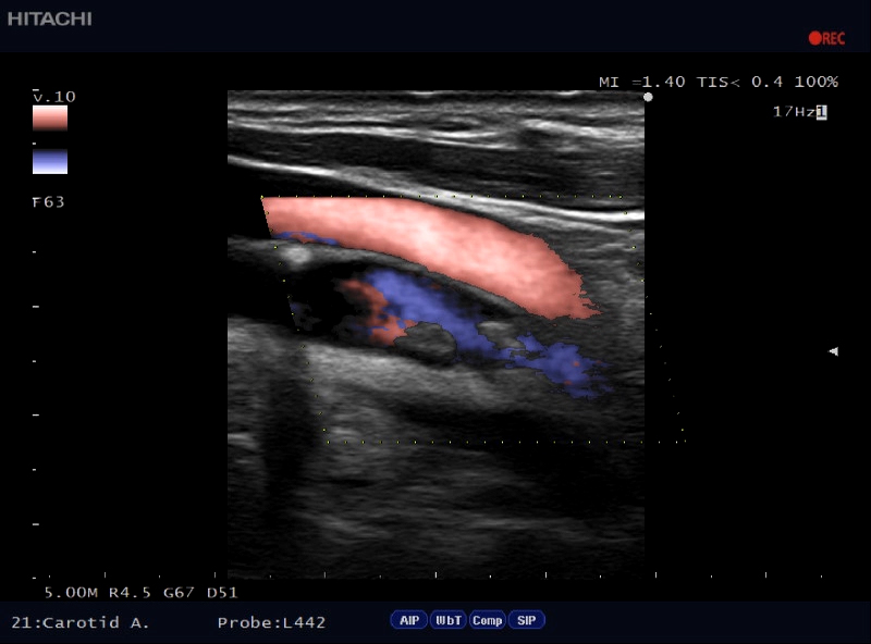 eflow-carotid09