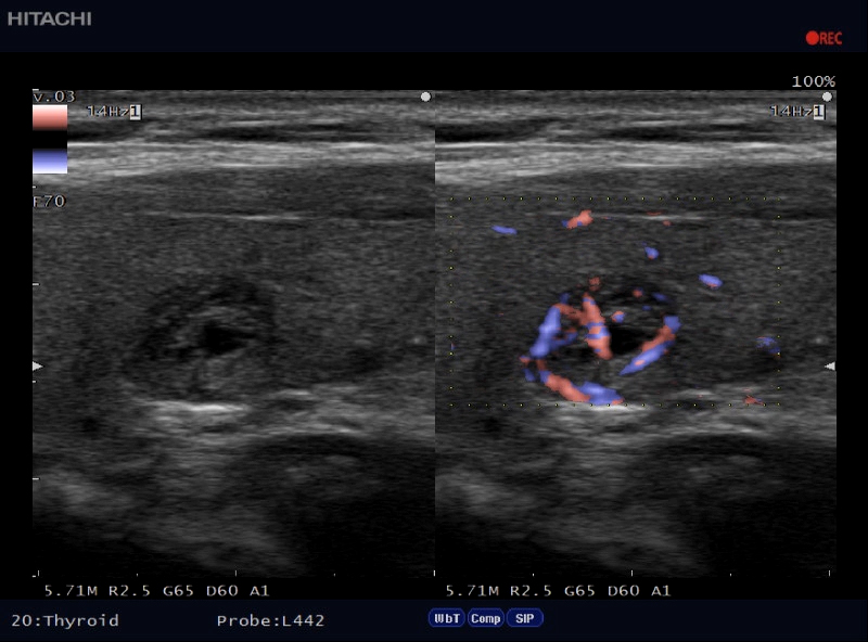 eflow-thyroid09