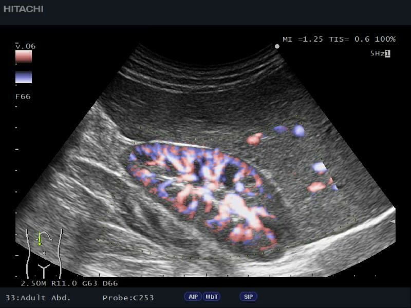 kidney-eflow-liver-9BB5619B