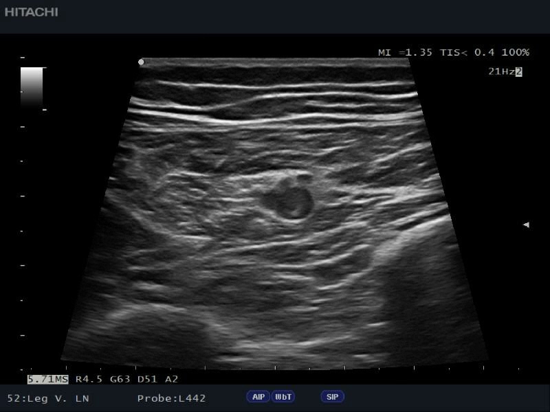 leg-vessels-b-ECEE1BD7